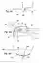 Fig. 07 - Apparatus and method for treating female urinary incontinence