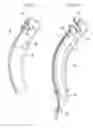 Fig. 04 - SYSTEMS AND METHODS FOR ENDOSCOPIC INVERSION AND REMOVAL OF DIVERTICULA