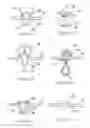 Fig. 11 - SYSTEMS AND METHODS FOR ENDOSCOPIC INVERSION AND REMOVAL OF DIVERTICULA