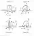 Fig. 13 - SYSTEMS AND METHODS FOR ENDOSCOPIC INVERSION AND REMOVAL OF DIVERTICULA