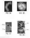Fig. 04 - Method and system for multi-component heart and aorta modeling for decision support in cardiac disease