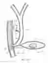 Fig. 09 - System and method for fiducial deployment via slotted needle