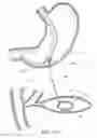 Fig. 10 - System and method for fiducial deployment via slotted needle