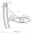 Fig. 11 - System and method for fiducial deployment via slotted needle