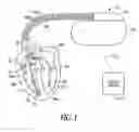 Fig. 02 - Atrial arrhythmia detection and discrimination based on intracardiac impedance