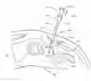 Fig. 01 - FINE NEEDLE BIOPSY SYSTEM AND METHOD OF USE