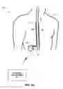 Fig. 02 - Therapy system including multiple posture sensors