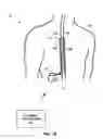 Fig. 03 - Therapy system including multiple posture sensors
