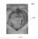 Fig. 04 - MEDICAL DEVICE FOR SHRINKING OPEN WOUNDS