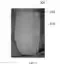 Fig. 05 - MEDICAL DEVICE FOR SHRINKING OPEN WOUNDS