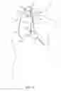 Fig. 02 - Methods and systems for establishing retrograde carotid arterial blood flow