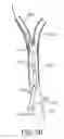 Fig. 07 - Methods and systems for establishing retrograde carotid arterial blood flow