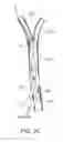 Fig. 08 - Methods and systems for establishing retrograde carotid arterial blood flow