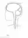 Fig. 02 - BIDIRECTIONAL CEREBRAL SPINAL FLUID INFUSION CATHETER WITH COOLING MECHANISM AND METHOD OF USE