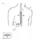Fig. 01 - Posture-responsive therapy control based on patient input
