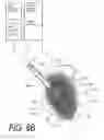 Fig. 12 - Bone treatment systems and methods