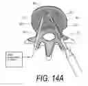 Fig. 19 - Bone treatment systems and methods