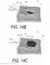Fig. 20 - Bone treatment systems and methods