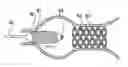 Fig. 01 - Method and system for delivery of coated implants