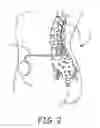 Fig. 03 - SNAP-ON SUTURE RING FOR IMPLANTABLE MEDICAL DEVICE