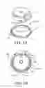 Fig. 09 - SNAP-ON SUTURE RING FOR IMPLANTABLE MEDICAL DEVICE