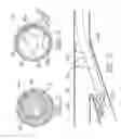 Fig. 05 - ATHERECTOMY SYSTEM WITH IMAGING GUIDEWIRE