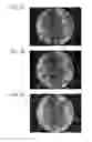 Fig. 08 - Endoscopic heart surgery method