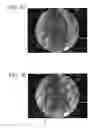 Fig. 09 - Endoscopic heart surgery method