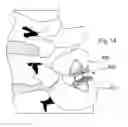 Fig. 06 - Spinal stabilization devices, systems, and methods