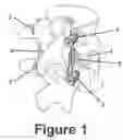 Fig. 02 - Novel V construct and method of spinal stabilization after transforminal lumbar interbody fusion  using the construct