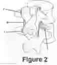 Fig. 03 - Novel V construct and method of spinal stabilization after transforminal lumbar interbody fusion  using the construct