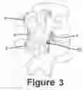 Fig. 04 - Novel V construct and method of spinal stabilization after transforminal lumbar interbody fusion  using the construct