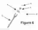 Fig. 07 - Novel V construct and method of spinal stabilization after transforminal lumbar interbody fusion  using the construct