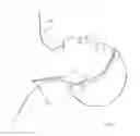 Fig. 02 - Method of lateral facet approach, decompression and fusion using screws and staples as well as arthroplasty