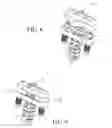 Fig. 09 - Method of lateral facet approach, decompression and fusion using screws and staples as well as arthroplasty
