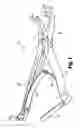 Fig. 02 - Reducing instrument for spinal surgery