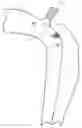 Fig. 01 - Percutaneous method and device to treat dissections