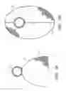 Fig. 04 - Percutaneous method and device to treat dissections