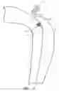 Fig. 06 - Percutaneous method and device to treat dissections