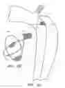 Fig. 07 - Percutaneous method and device to treat dissections