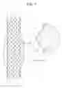 Fig. 02 - Drawstring for removal of stent