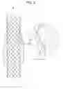 Fig. 03 - Drawstring for removal of stent