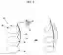 Fig. 09 - Drawstring for removal of stent