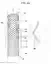 Fig. 24 - Drawstring for removal of stent
