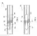 Fig. 04 - Method and Device for Localized Administration of Calcium Chelating Agent