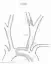 Fig. 03 - Implant delivery device
