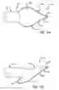 Fig. 04 - VASCULAR GRAFT PROSTHESIS HAVING A REINFORCED MARGIN FOR ENHANCED ANASTOMOSIS