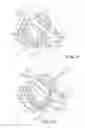 Fig. 07 - Mitral Valve Device Using Conditioned Shape Memory Alloy