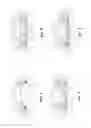 Fig. 02 - Adjustable accommodating intraocular lens and positioning means