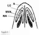 Fig. 06 - NASAL IMPLANT INTRODUCED THROUGH AN INJECTION TECHNIQUE